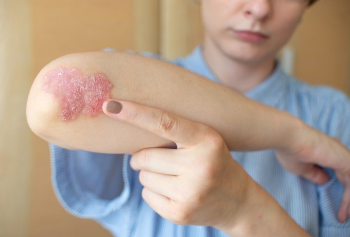 Psoriasis 2